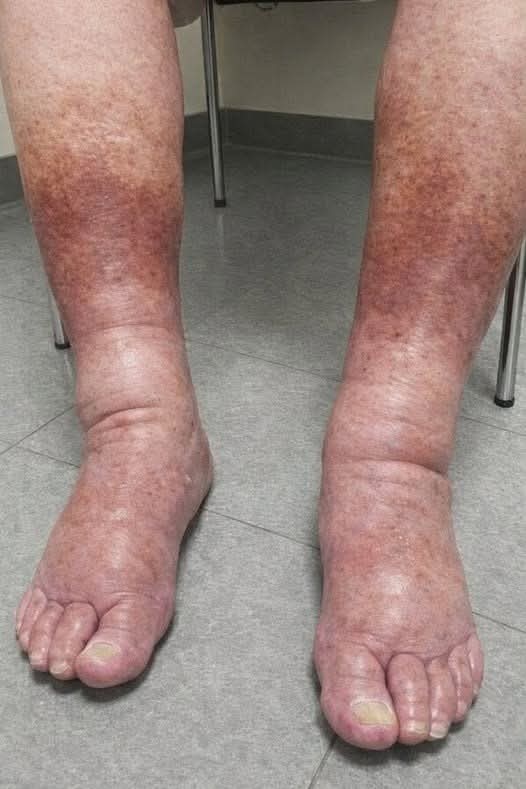 🚨 Señales en los pies y tobillos que no debes ignorar