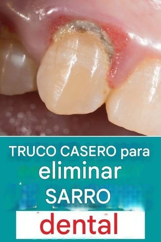 🦷 ¿Puedes eliminar el sarro dental en casa? Esto es lo que realmente dicen los dentistas