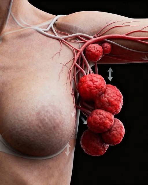 🚨 Cáncer de mama: 4 señales tempranas que podrían aparecer antes de lo que imaginas