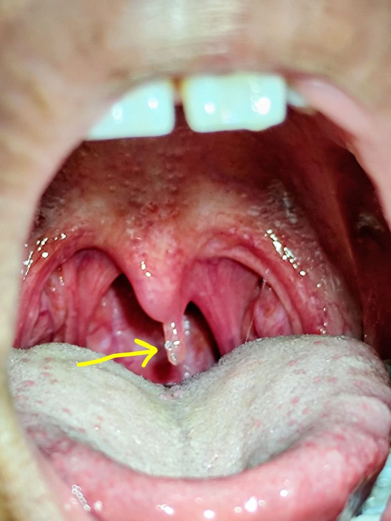 😷 Señales en la garganta que podrían indicar un problema de salud