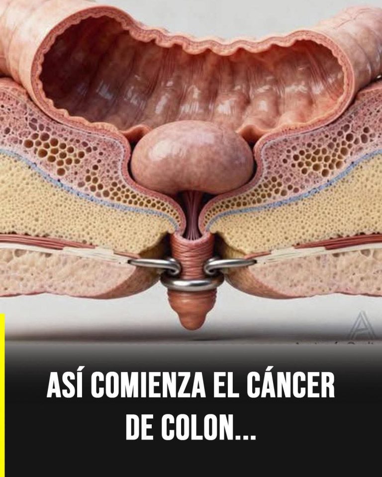 🚨 Así comienza el cáncer de colon: las señales silenciosas que casi nadie nota