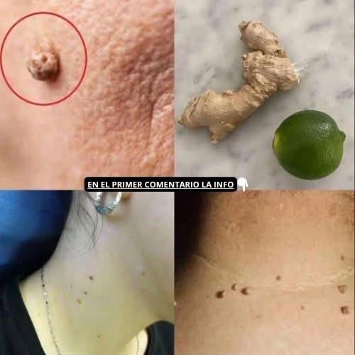 🚨 ¿Tienes verrugas? Lo que muchas personas están probando en casa está sorprendiendo