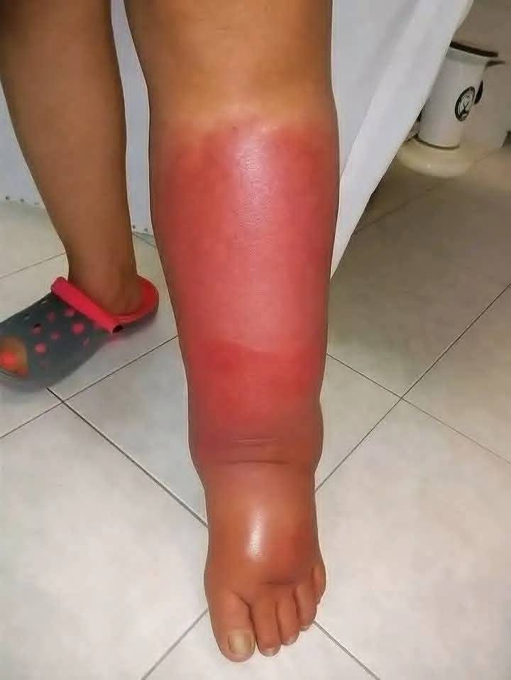 🚨 Estos síntomas en la pierna pueden ser una señal de alerta que no debes ignorar