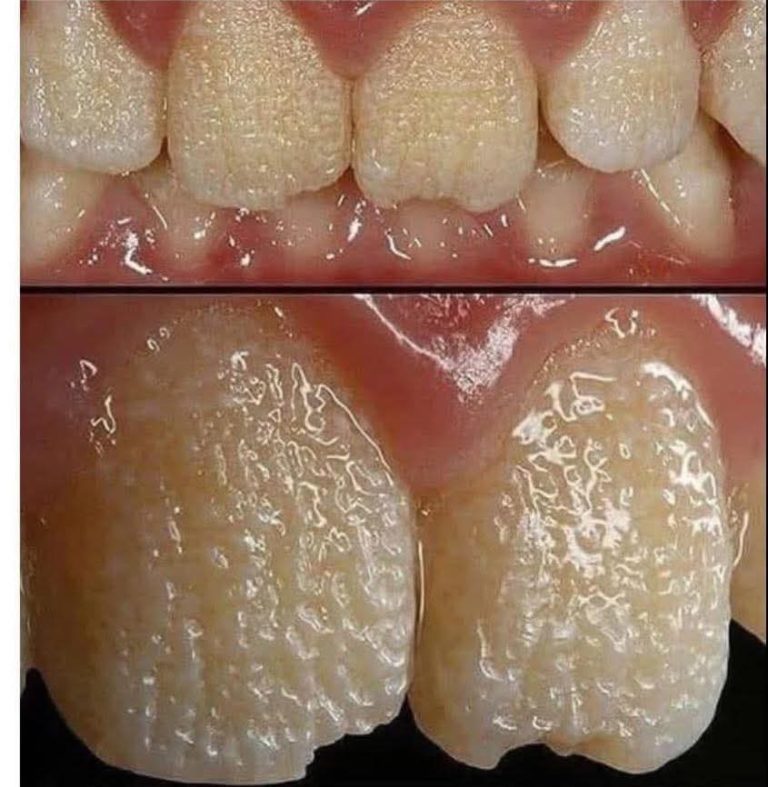 🚨 Cuidado: si tus dientes lucen así, tu cuerpo podría estar alertándote