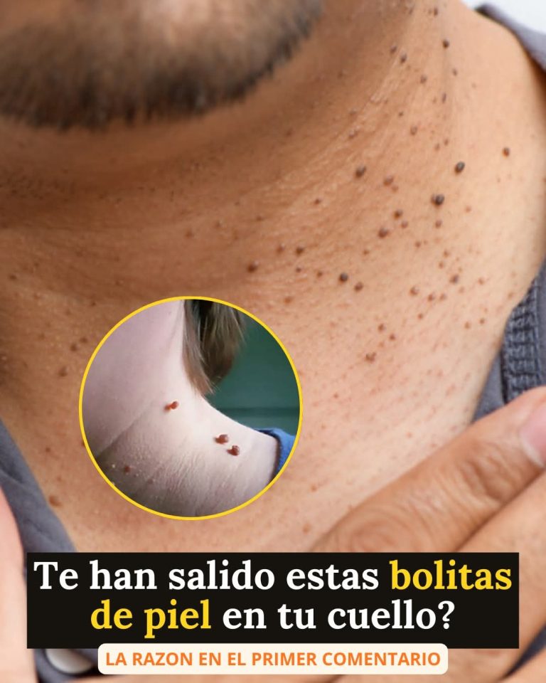 🚨 ¿Te han salido bolitas de piel en el cuello? Esto es lo que tu cuerpo podría estar diciendo