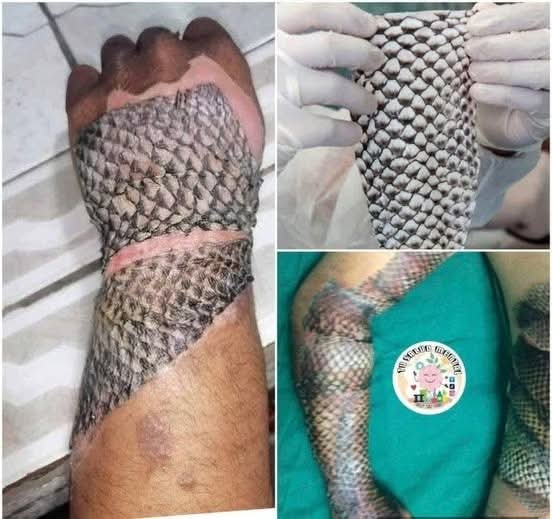 😨 La piel de tilapia está cambiando la vida de personas con graves quemaduras