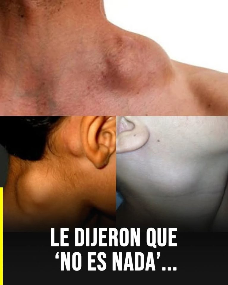 Ganglios inflamados sin dolor: la señal silenciosa que muchas personas ignoran durante semanas