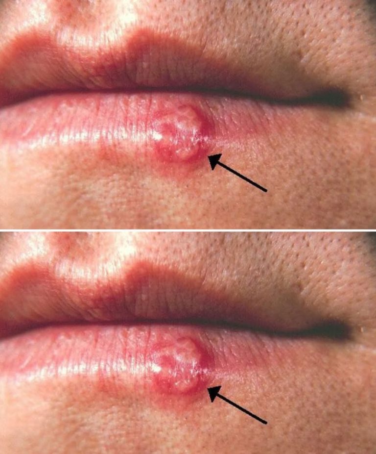 Si te aparece esto en los labios, tu cuerpo podría estar enviando una señal importante