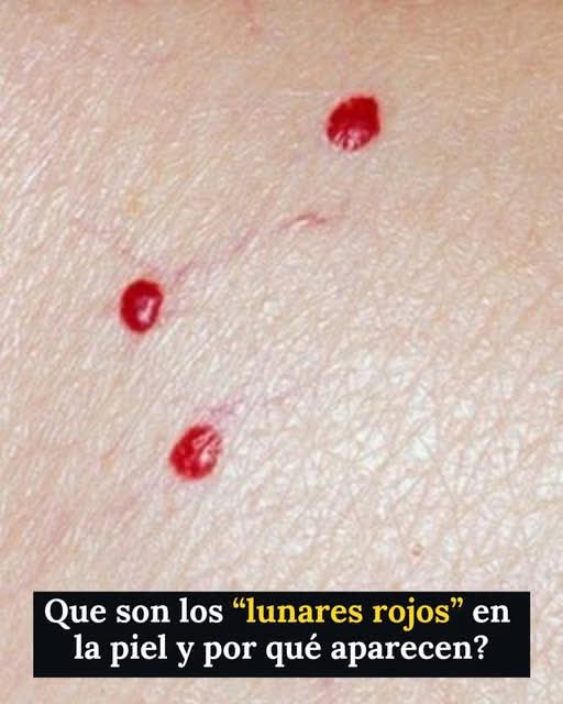 ¿Te han salido “lunares rojos”? Esto es lo que realmente podrían indicar en la piel