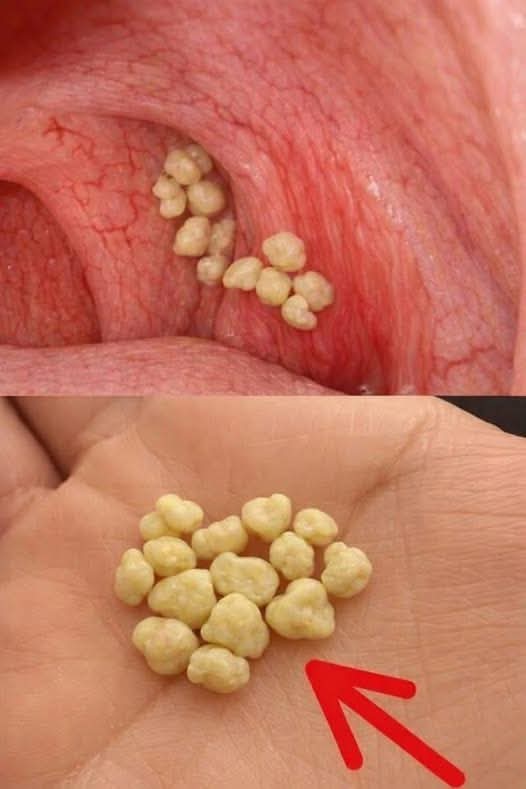 😳 ¿Te salen estas bolitas blancas en la garganta? Podrían estar diciendo más de lo que imaginas