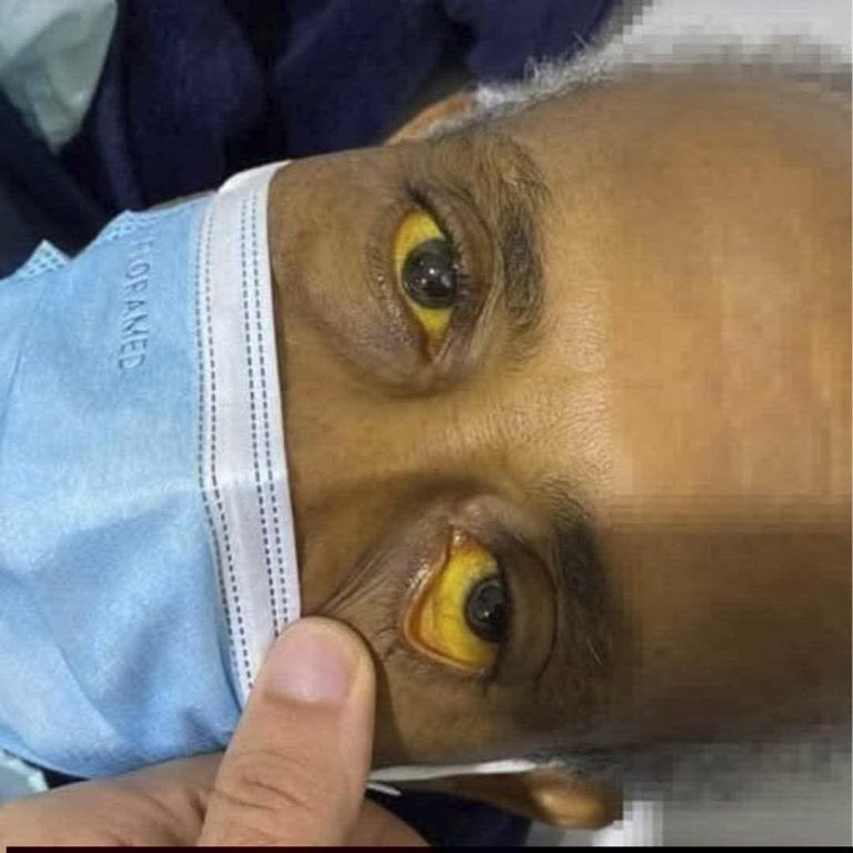 😳 Médicos advierten sobre una señal en los ojos que muchas personas están ignorando
