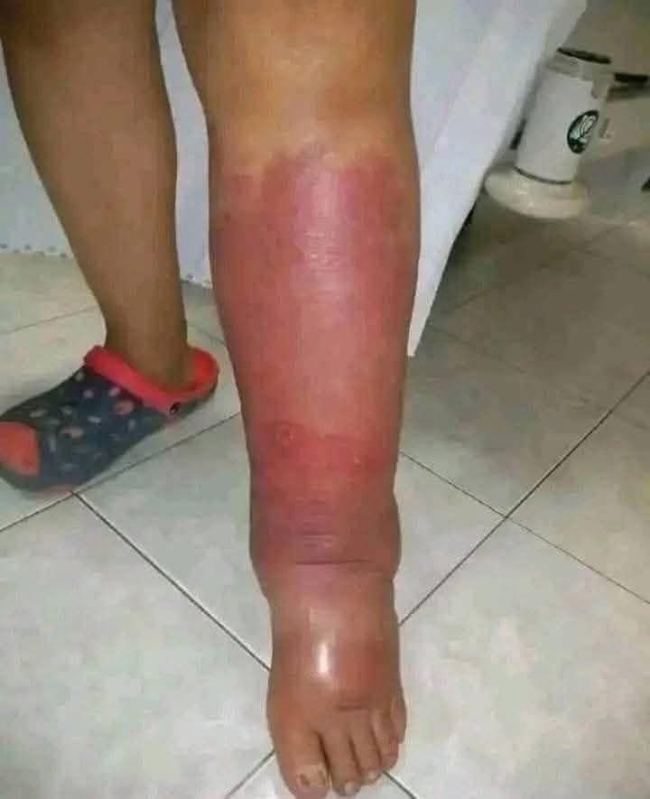 🚨 Estos son signos peligrosos que podrían alertar sobre una grave infección en la piel