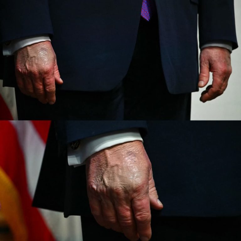 😳🔥 Se viralizan las manos de Trump durante evento en la Casa Blanca y desatan teorías en redes