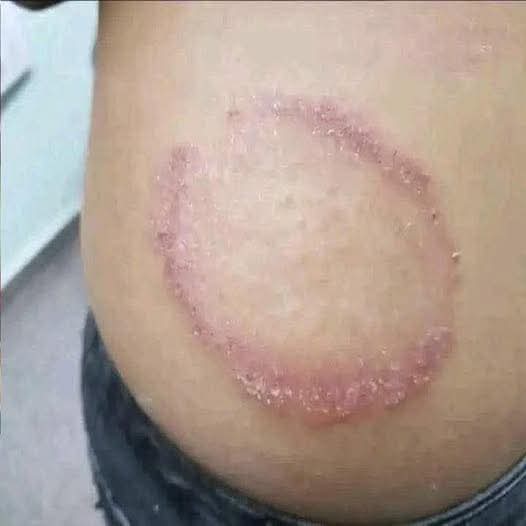 😨 Esta extraña marca en la piel podría estar alertando sobre un problema que muchos ignoran