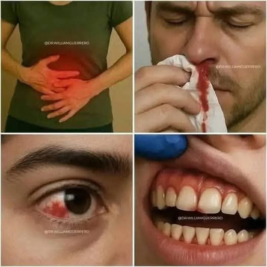 🚨 Estos son los signos que podrían alertar sobre una grave enfermedad en la sangre