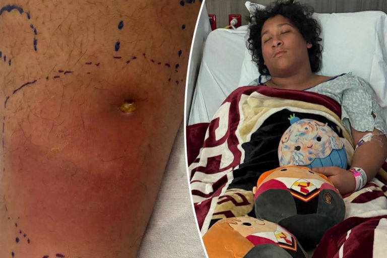Adolescente lucha por su vida tras contraer una bacteria “come carne” después de nadar en un parque de Florida