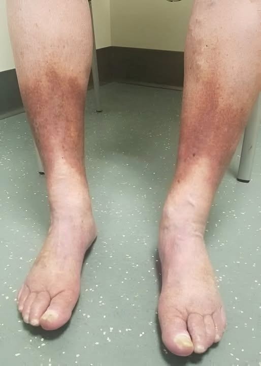 Señales en los pies y tobillos que podrían indicar mala circulación
