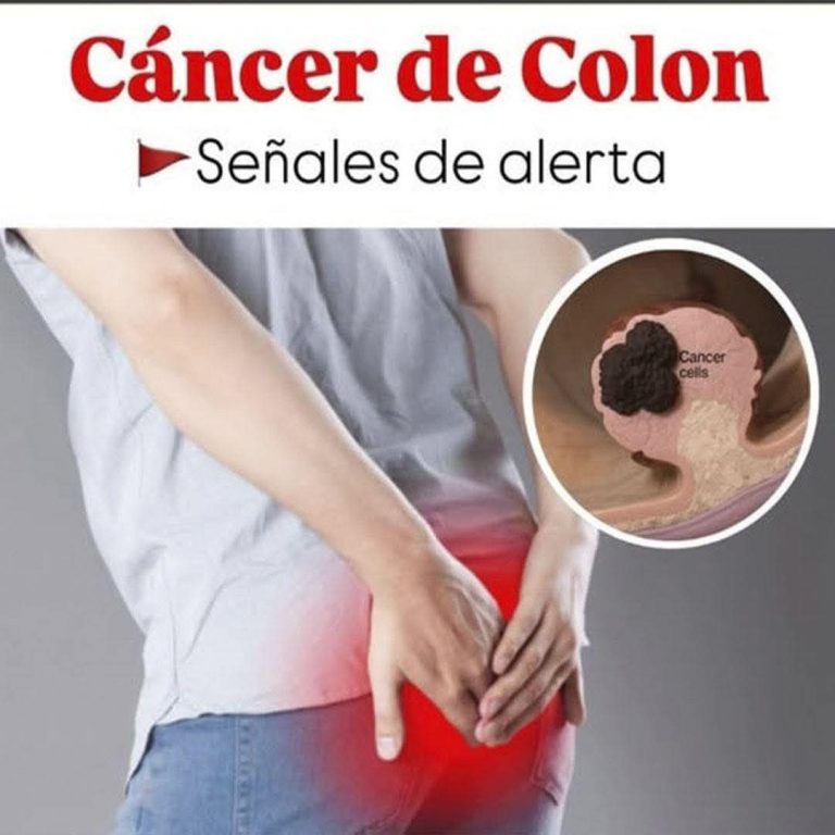 🚨 Estos son los síntomas del cáncer de colon que muchas personas ignoran durante meses