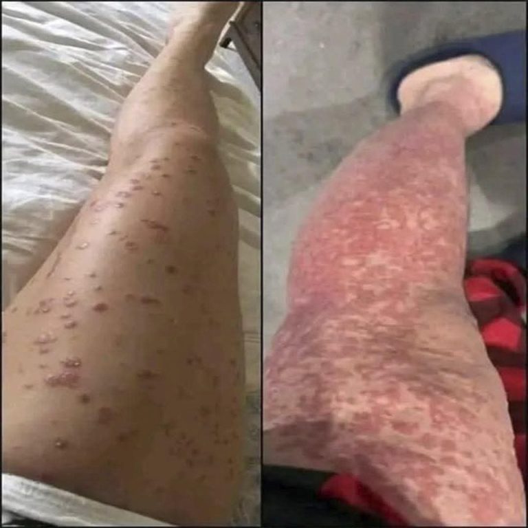 🚨😱 Estas son las consecuencias de ignorar esta enfermedad que comienza con pequeñas manchas en la piel