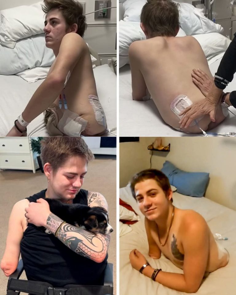 El caso de Loren Schauers: el joven que sobrevivió tras perder la mitad de su cuerpo en un accidente laboral