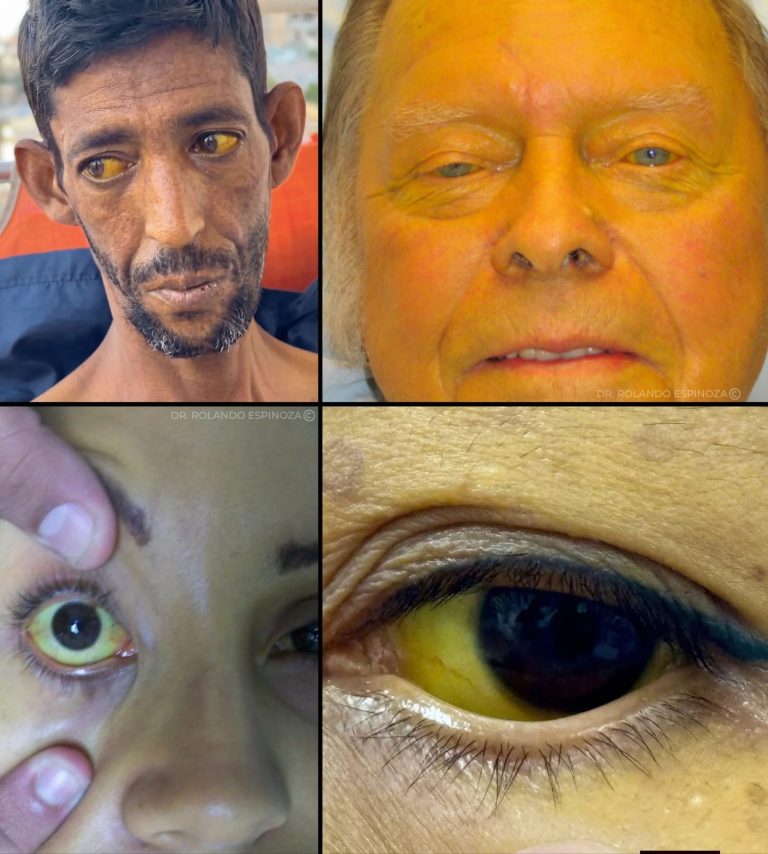 Ictericia: la señal visible que puede advertir problemas graves en el hígado