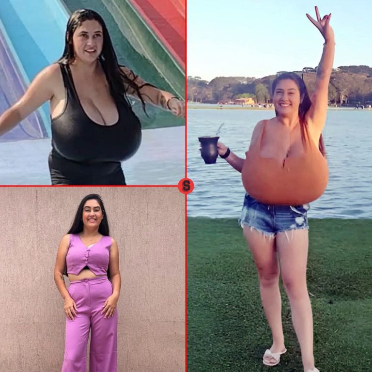 Joven brasileña supera rara condición de gigantomastia tras cirugía de más de 10 horas