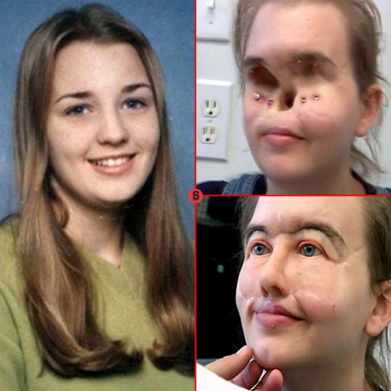 La impactante historia de Chrissy: sobrevivió a un accidente devastador y una prótesis facial transformó su vida años después