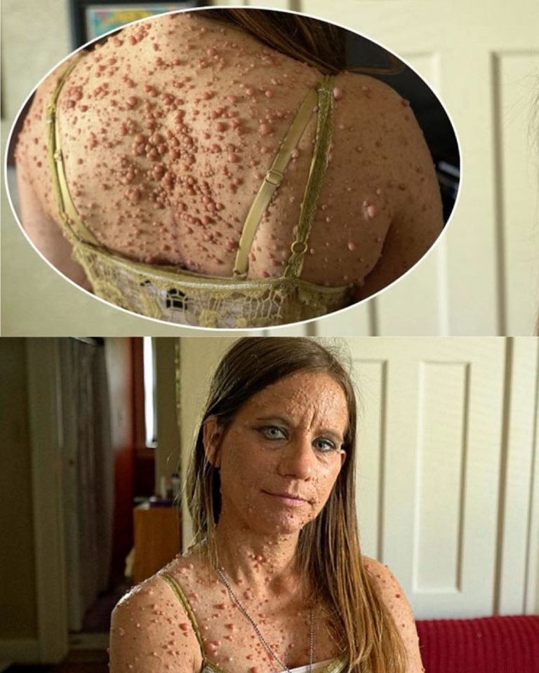 ¿Cuáles son los primeros síntomas de la neurofibromatosis? La condición genética que muchas personas desconocen