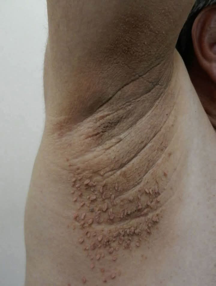 ¿Cambios extraños en las axilas? Estas señales podrían estar relacionadas con problemas de salud que no debes ignorar