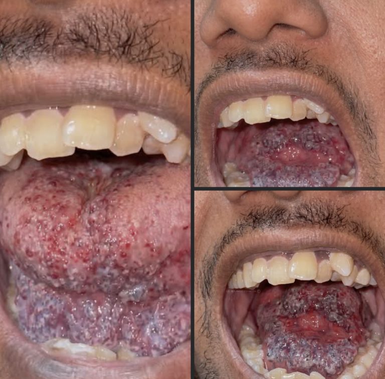 Lesiones en la lengua: señales de alerta que podrían revelar problemas de salud bucal
