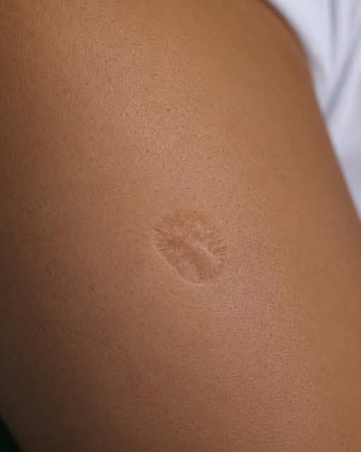 ¿Por qué la vacuna BCG deja una cicatriz en el brazo? La explicación científica detrás de una marca que muchos tienen