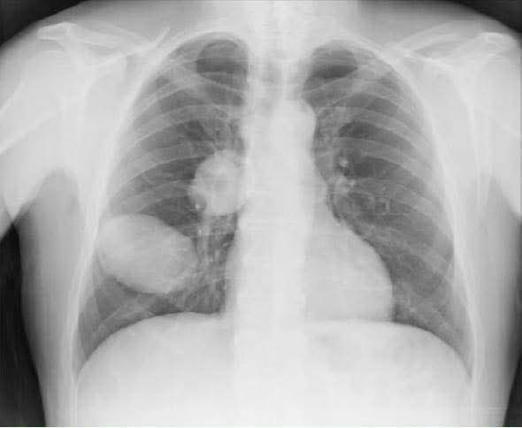 La tos que parecía una simple bronquitis escondía dos quistes gigantes en sus pulmones: el caso que sorprendió a los médicos