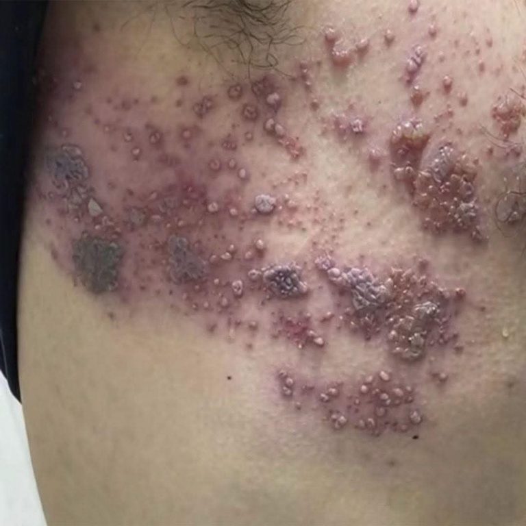 Estas señales en la piel podrían indicar una infección que no debes ignorar
