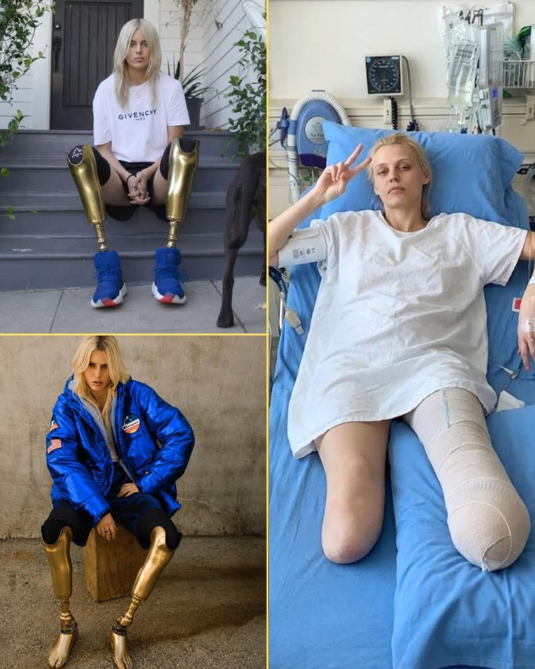 Modelo perdió ambas piernas por una infección y volvió a brillar en las pasarelas
