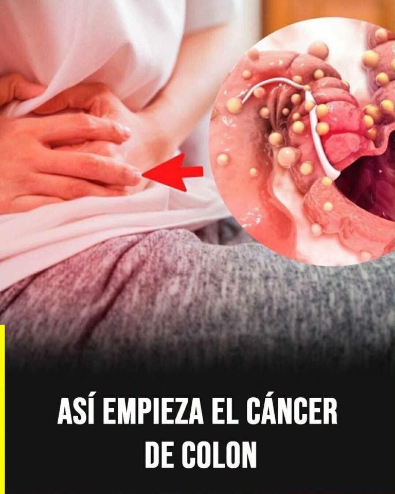 Cáncer de Colon: Las Señales Tempranas que Muchas Personas Confunden con Problemas Digestivos Comunes