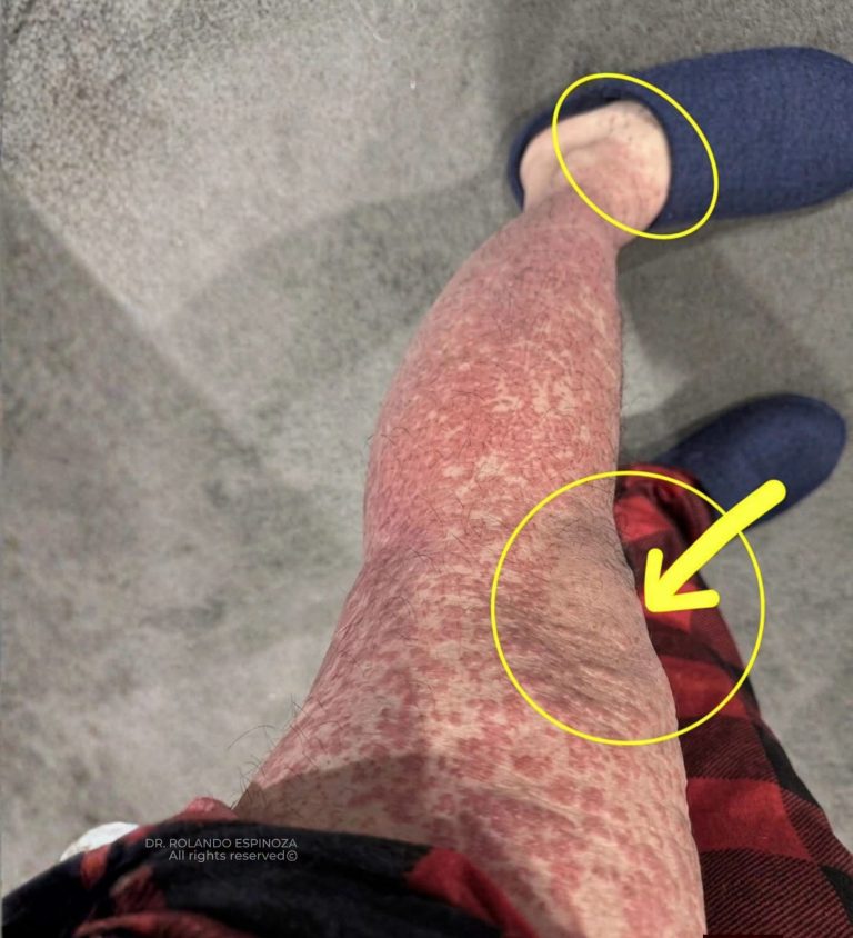 ¿Crees que es una alergia? La señal en la piel que podría estar relacionada con una inflamación de los vasos sanguíneos