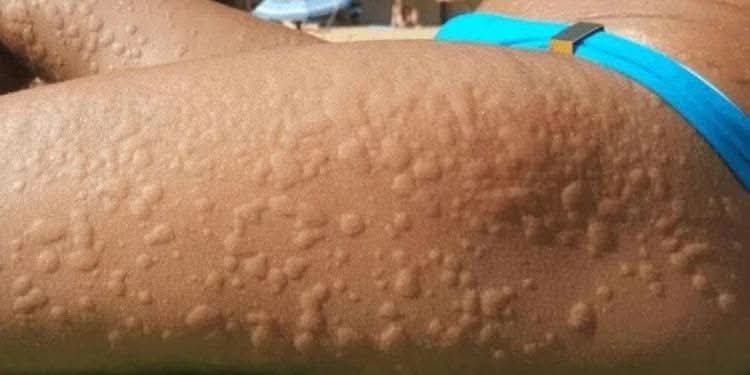 Picazón intensa en la piel: cuando no se trata de una simple alergia