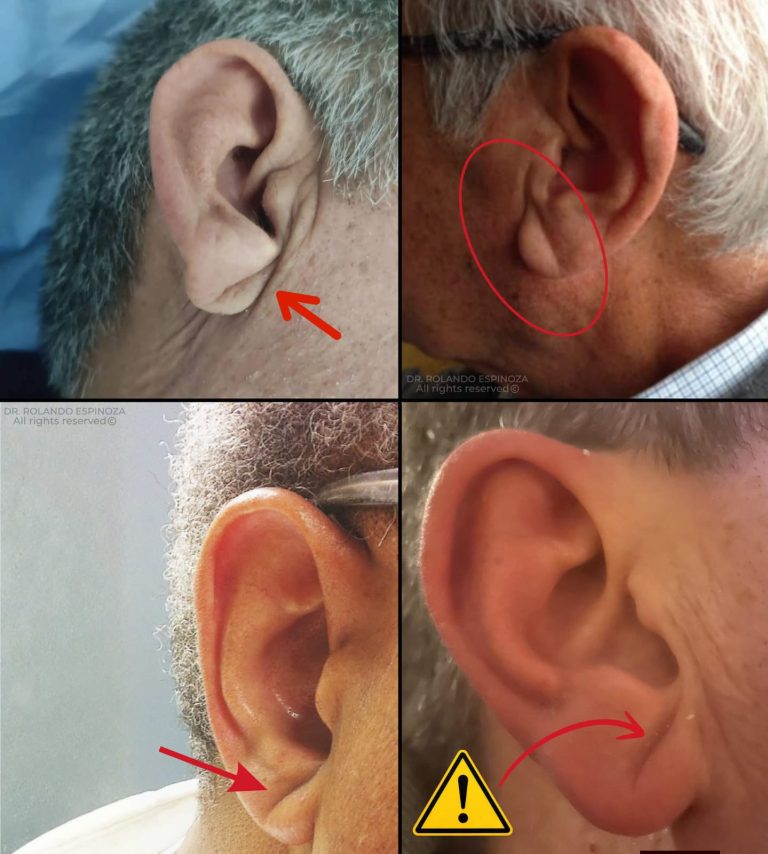 Signo de Frank: qué significa la rayita en la oreja y cuándo revisar tu corazón