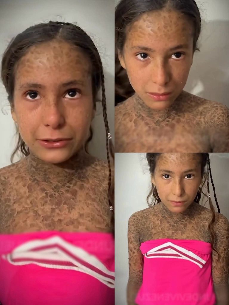 Niña enfrenta una difícil enfermedad en la piel y su familia pide ayuda