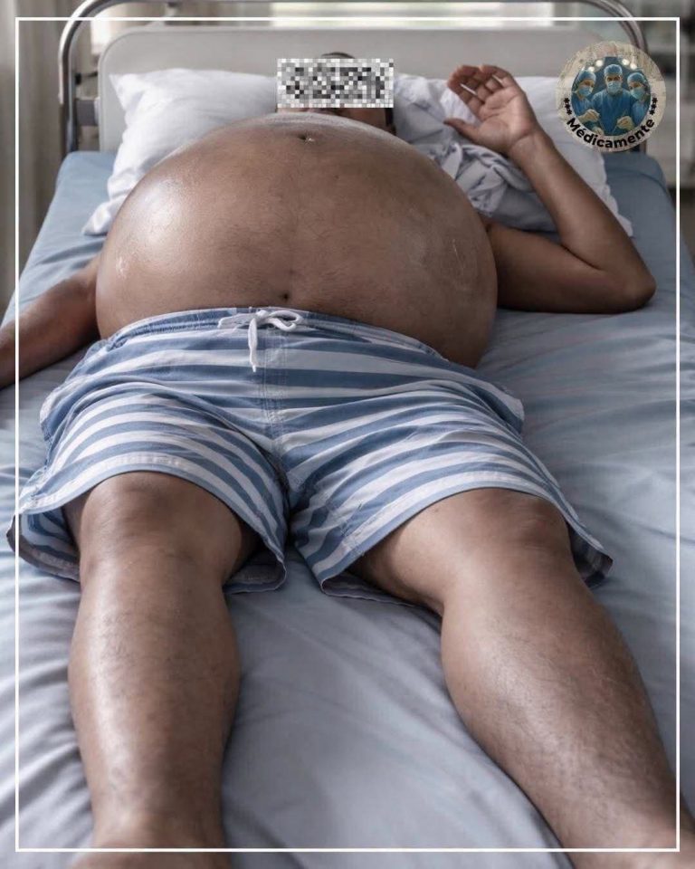 Abdomen hinchado por alcohol: la señal grave que muchos ignoran