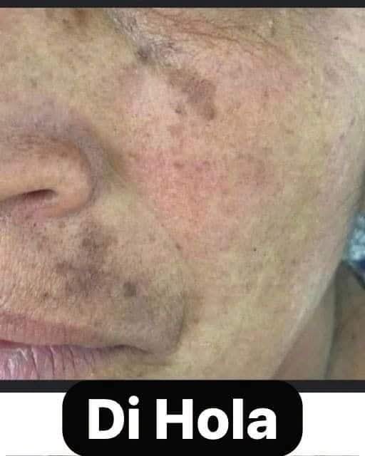 ¿Tienes manchas oscuras en la piel? Esto es lo que podrían indicar y cuándo consultar a un especialista