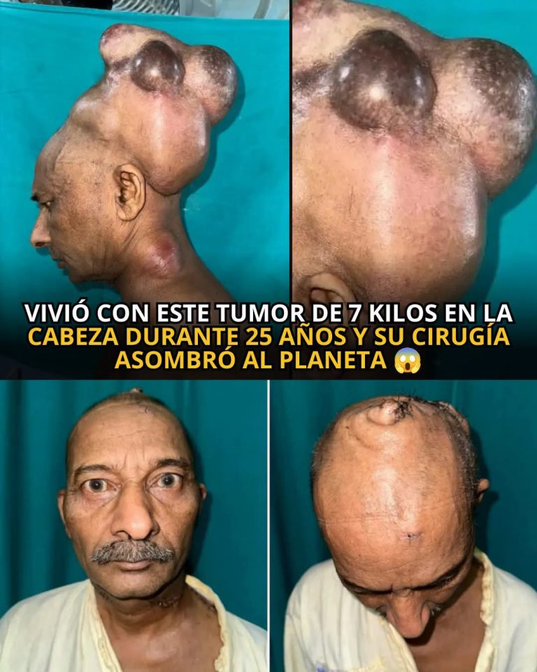 Vivió durante 25 años con un enorme tumor en la cabeza: la compleja cirugía que cambió su vida