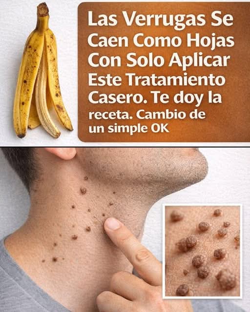 ¿La cáscara de plátano elimina las verrugas? Lo que realmente dice la ciencia y cuáles son los tratamientos que sí funcionan